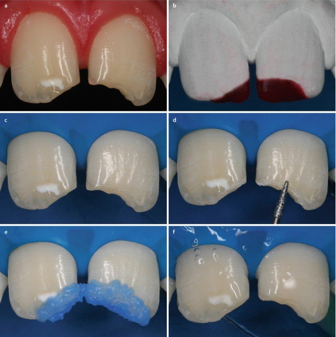 anterior tooth fracture composite restoration young patient