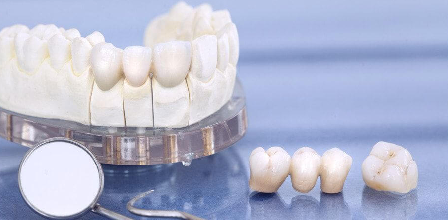 Prothèse fixée dentaire - vue générale