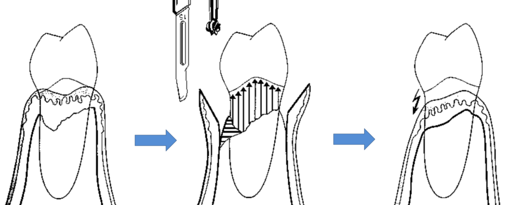 chirurgie résective