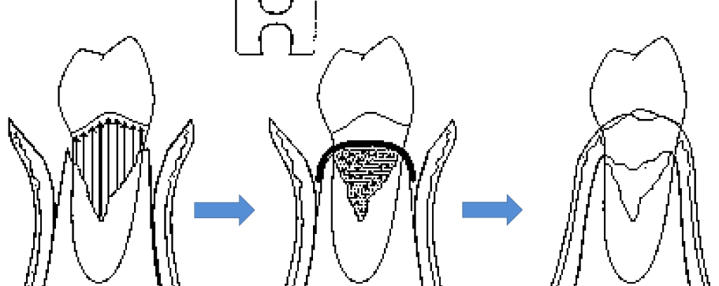 régénération tissulaire guidée (RTG).