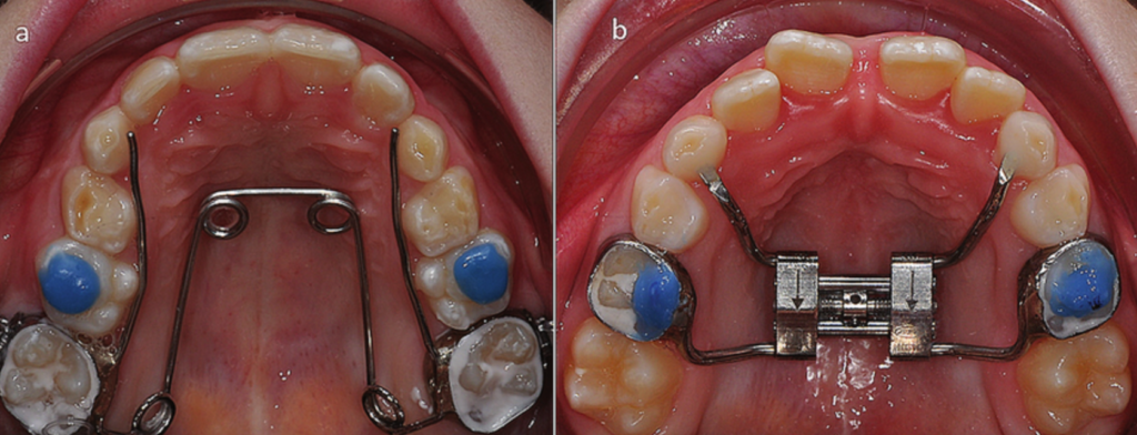 Distalisation des secteurs latéraux (en cas de mésialisation secondaire à une extraction précoce) :