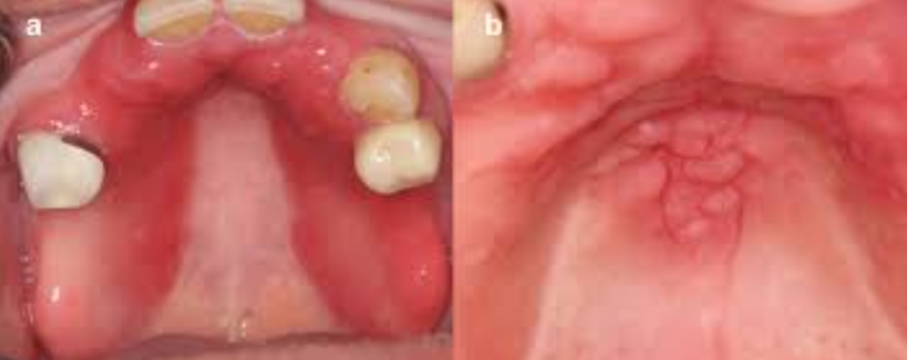 denture stomatitis palate erythema prosthesis