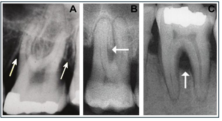 Les zones radiotransparentes indiquent une atteinte de la furcation (flèches). A. Atteinte de la furcation sur les faces mésiale et distale
de la première molaire supérieure gauche ; B. Atteinte de la furcation sur la face vestibulaire de la première molaire supérieure droite ; C. Atteinte de la furcation
visible sur une radiographie de la première molaire inférieure gauche.