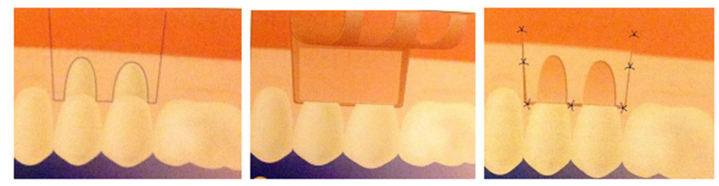 Greffe de conjonctif selon la technique de Langer, (de gauche à droite) : tracé
d'incision du lambeau muco-gingival, adaptation du greffon conjonctif sur le site
receveur, suture du lambeau repositionné in situ. 