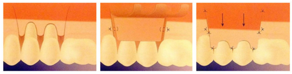  Greffe de conjonctif associée à un LPC (de gauche à droite) : Incisions,
suture du greffon, traction coronaire du lambeau
