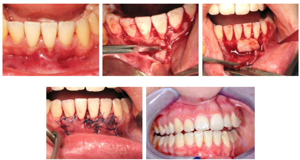 Greffe de conjonctif enfoui (de gauche à droite) : Vue Préopératoire avec récession sur 31 ; réalisation du lambeau, suture du greffon au site receveur ; Traction coronaire du lambeau pour recouvrir le greffon et sutures ; Vue à 2 mois postopératoire.