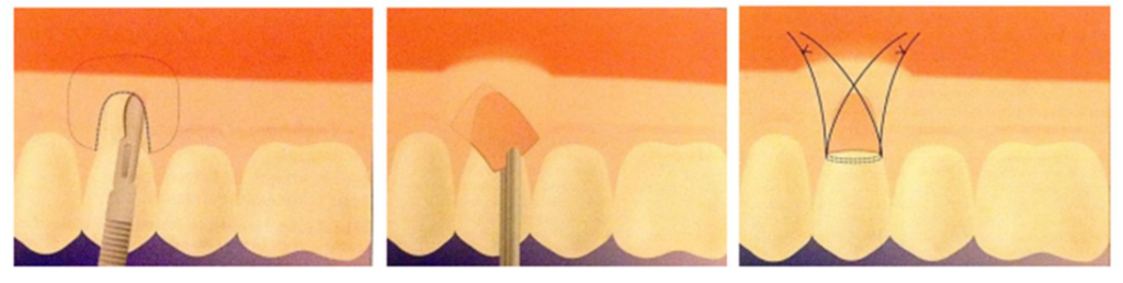 Technique de l’enveloppe : Incision séculaire en épaisseur partielle, mise en place du greffon dans l'enveloppe, sutures.