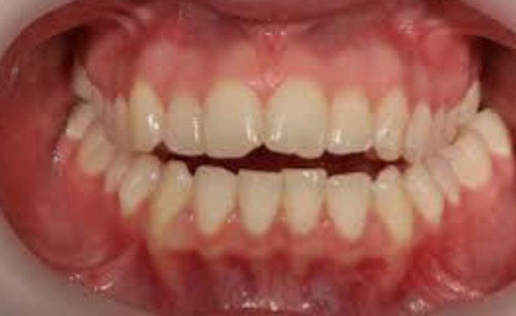 Photo clinique d'une béance antérieure