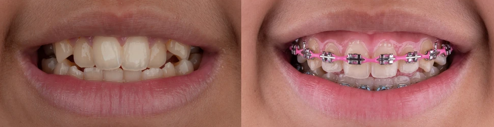 consultation orthodontique avant après modèles dentaires