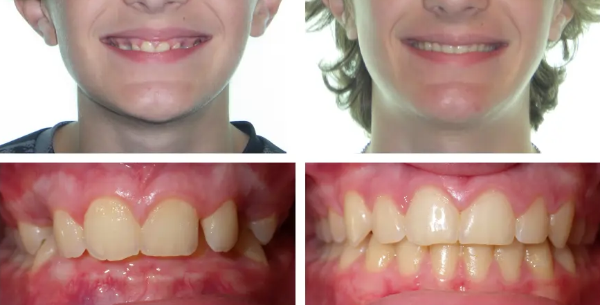 patient souriant après traitement orthodontique beau sourire