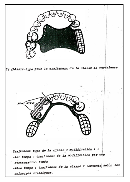 LE TRAITEMENT DES EDENTEMENTS DISTAUX