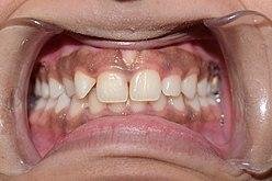 Résultat de recherche d'images pour "pigmentation ethnique gencive" Les lésions pigmentées de la muqueuse buccale