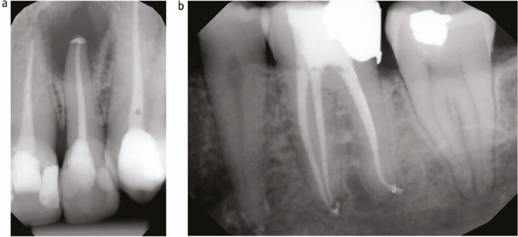 Radiographie montrant un dépassement apical
