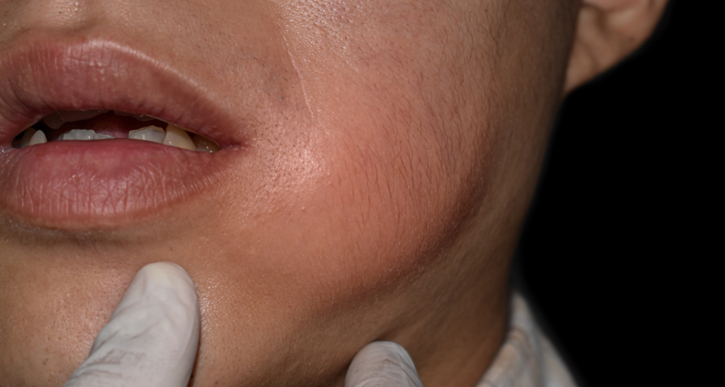 Œdème facial / tuméfaction (photo clinique neutre)