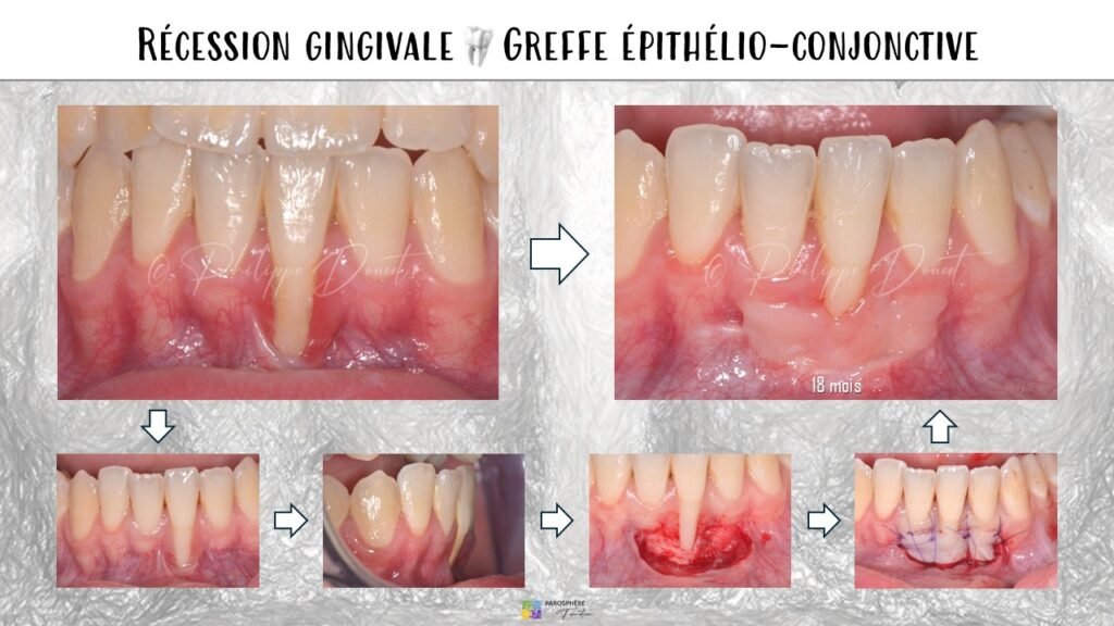 prélèvement du greffon épithélio-conjonctif 