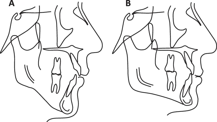 Schéma comparatif face longue vs face courte (hyperdivergent / hypodivergent)