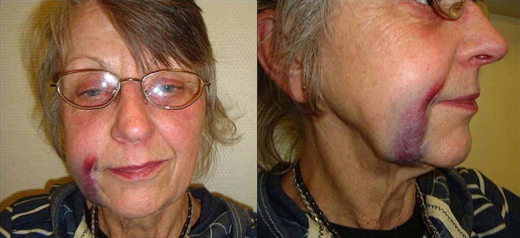 Hématome ou ecchymose facial légère