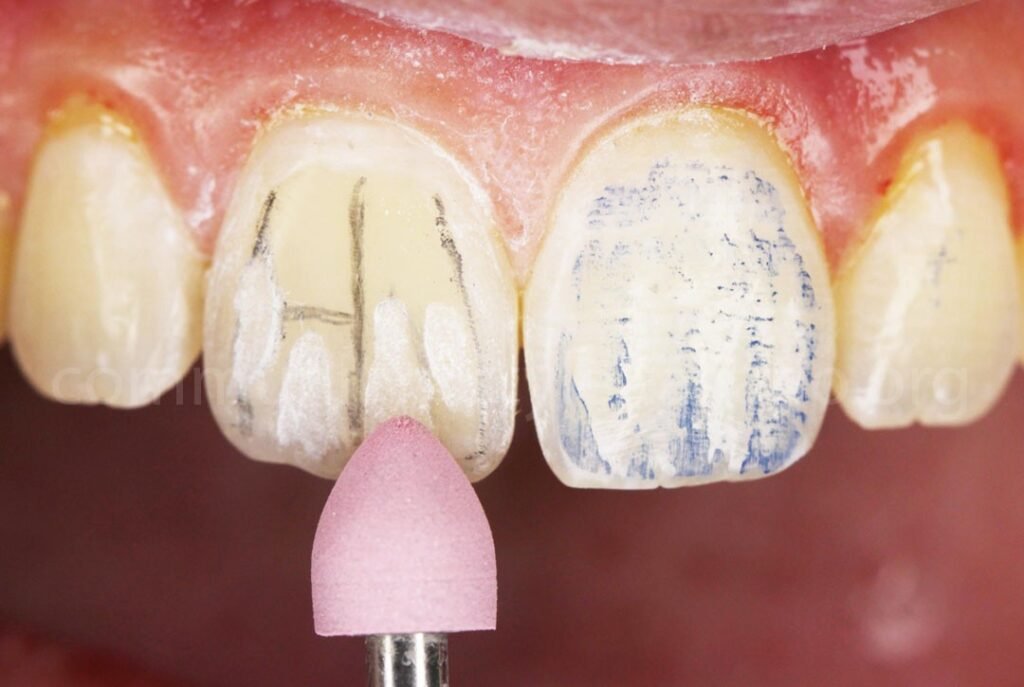 composite polishing finishing anterior tooth dental