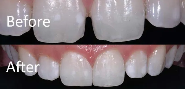 dental composite diastema closure incisor smile aesthetic