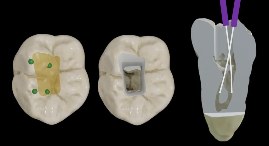 Vue macro d'une cavité d'accès endodontique sur molaire