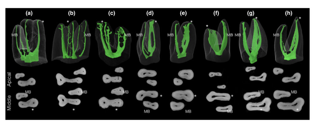 Vue microscopique d'un canal radiculaire