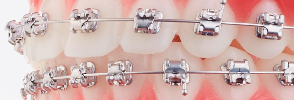  Vue rapprochée de brackets orthodontiques — la signature visuelle de la technique Edgewise.