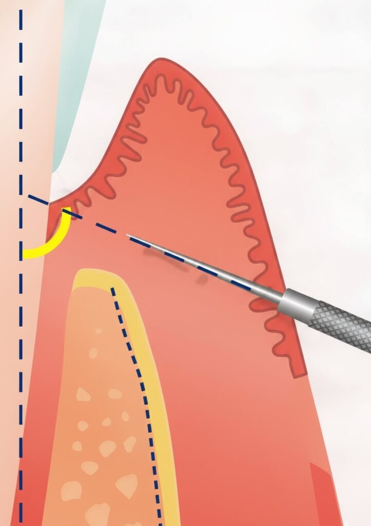 Gingivectomie à Biseau Externe (GBE)