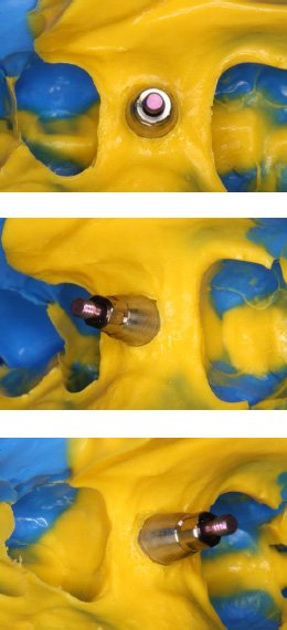 copper tube dental impression single unit