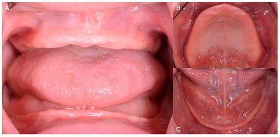 favorable vs unfavorable ridge complete denture anatomy
