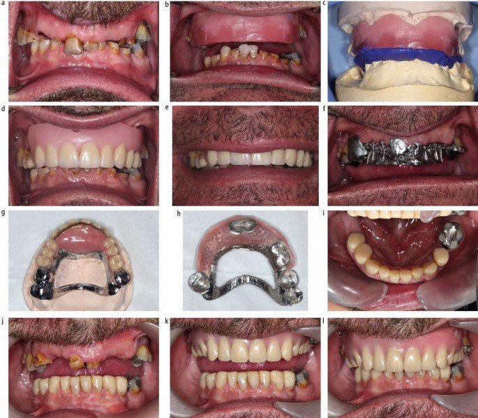 composite prosthesis partial denture final result mouth