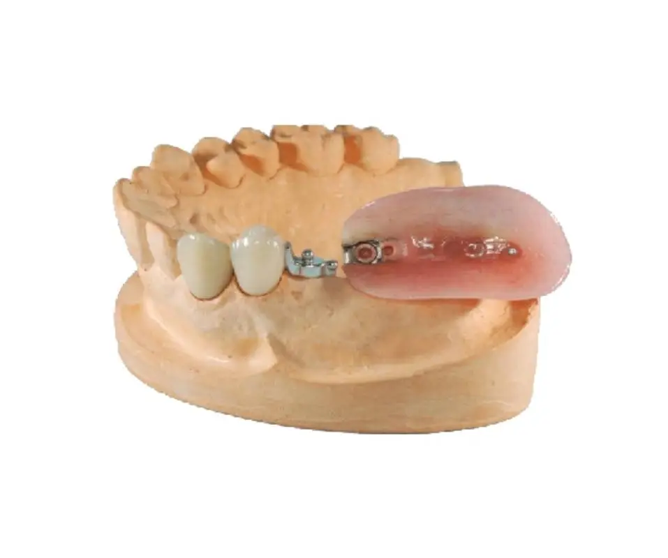 omega milling precision attachment partial denture diagram