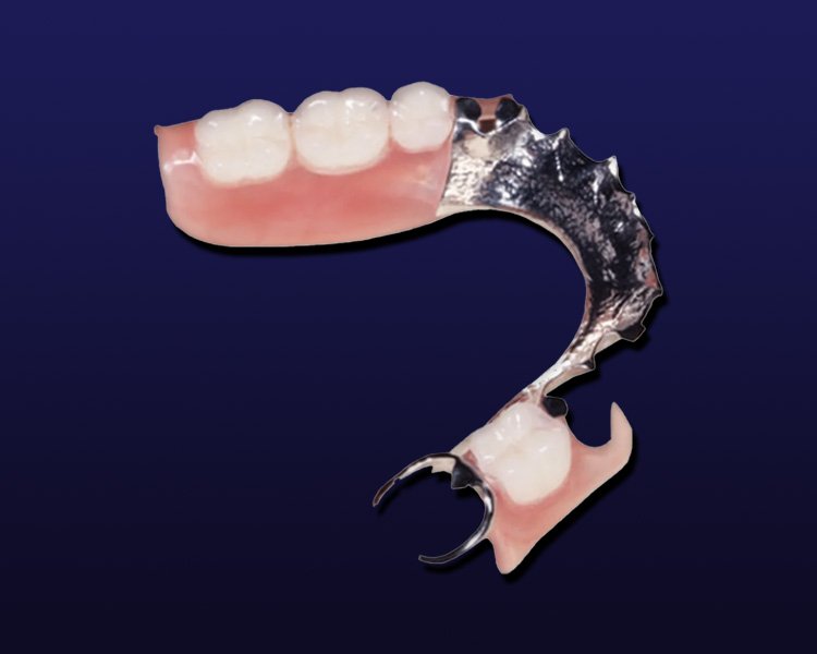 partial removable denture metal framework dental