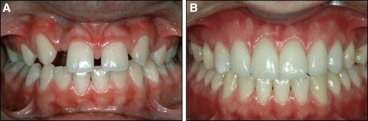 canine substitution orthodontic lateral incisor agenesis before after