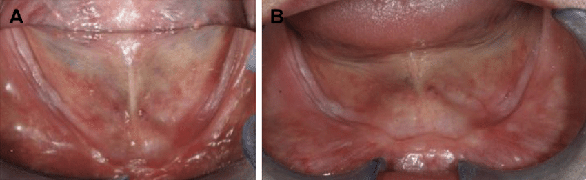 cuspal interference atrophic ridge complete denture tipping