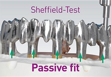 Sheffield test implant validation key plaster