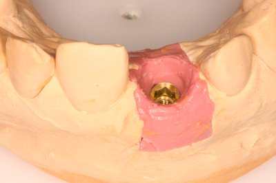 soft tissue silicone gingival mask implant model