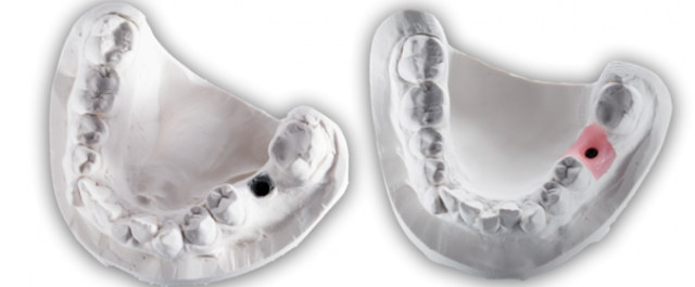 dental implant working model stone cast analog