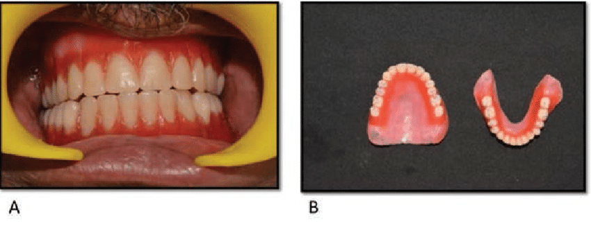 Contacts occlusaux lors du mouvement de protrusion mandibulaire en PAC