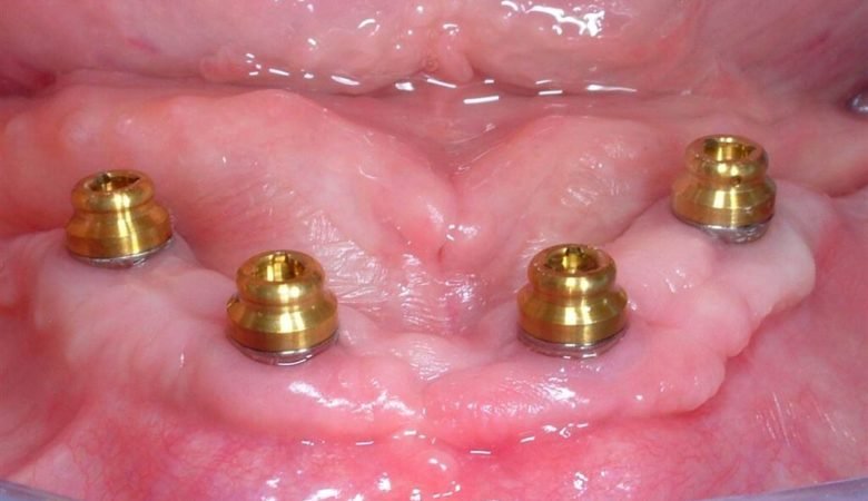 mandibular implant overdenture locator two implants