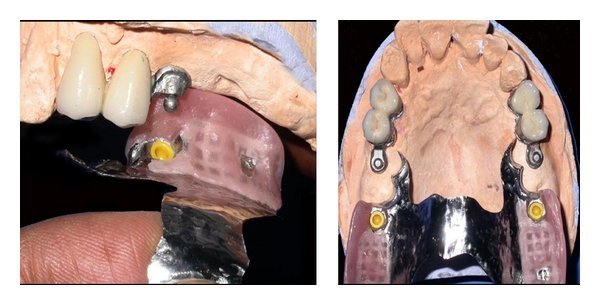 dental attachment extracoronal male female precision