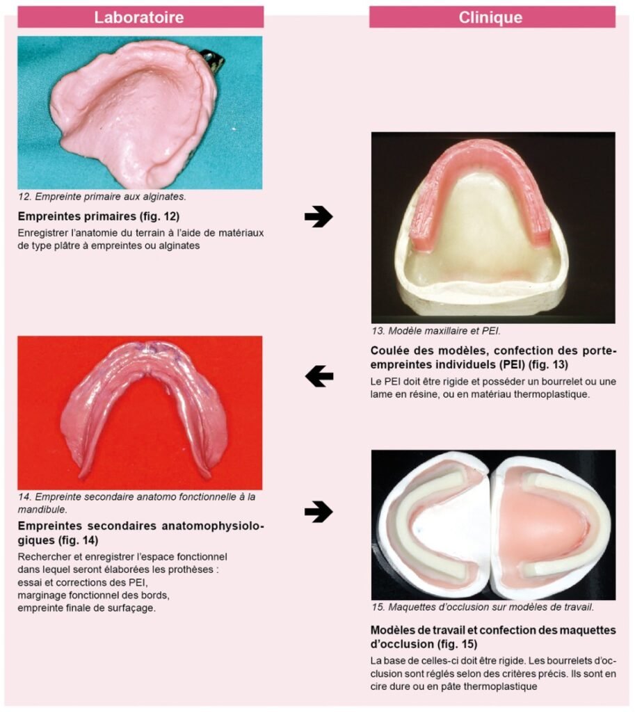anatomie buccale est indispensable à la conception d'une prothèse stable