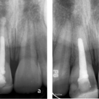 open apex immature tooth apexification radiograph Biodentine