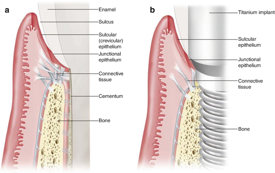 Schéma implant vs dent naturelle