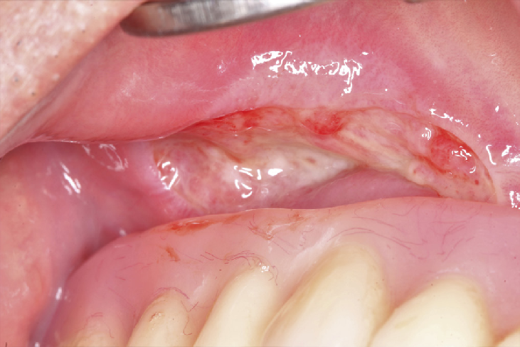 denture mucosal ulcer oral lesion