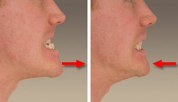 mandibular protrusion movement dental