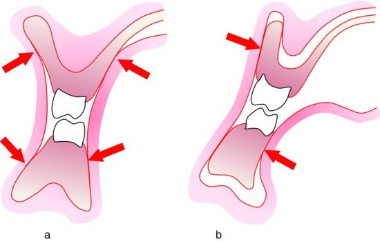 complete denture base mucosa support