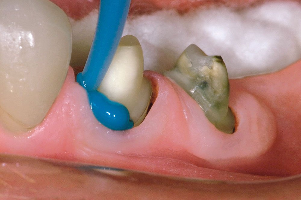 dental crown preparation molar impression