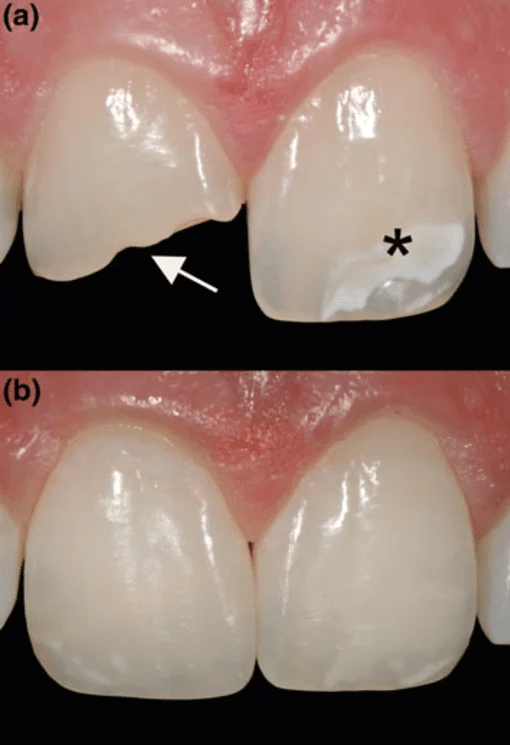 dental trauma incisor young patient