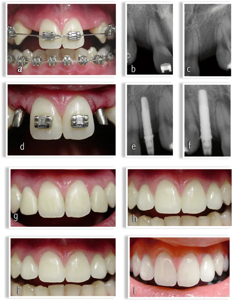 smile makeover orthodontic result agenesis lateral incisor esthetic
