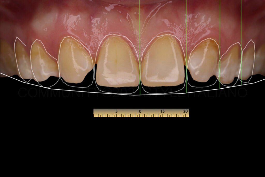 Traitement orthodontique — Fermeture des espaces"